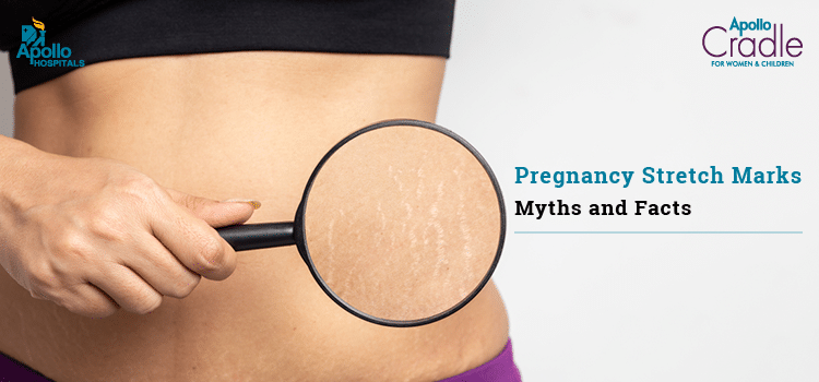 Pregnancy Stretch Marks- Myths and Facts