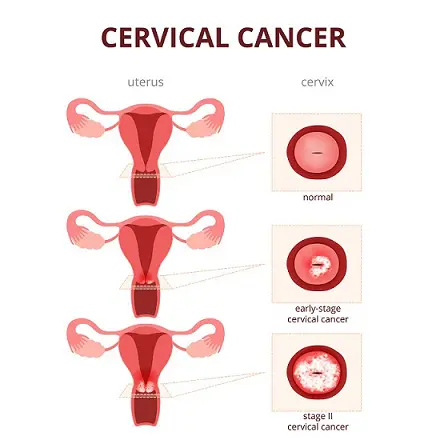 Low Grade Endometrial Carcinoma – A Case Study by Dr Seema Sharma